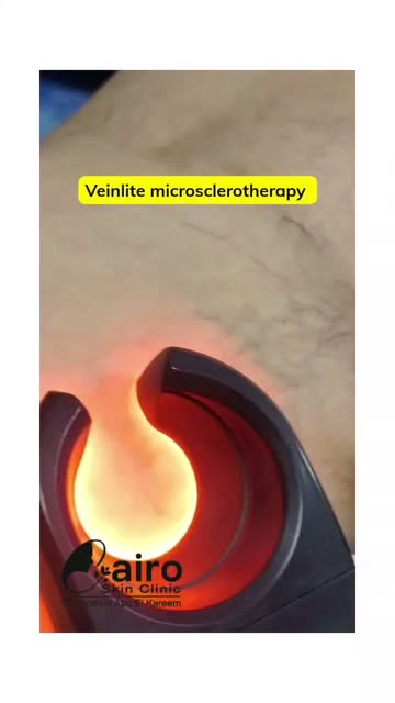 Veinlite assisted Microsclerotherapy 
اجراء فى العياده لحقن الشعيرات الدمويه السطحيه والتخلص منها نه
