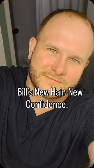 ✨ Bill’s Amazing Hair Transformation! ✨

Sometimes, it’s not just about getting your hair back—it’s 