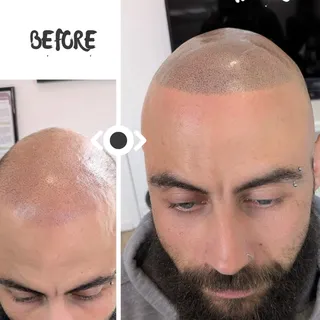 Tricopigmentation EFFET RASÉ