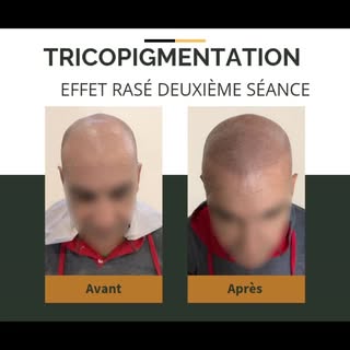 #calvitie #alopecie #pertedecheveux #pertedecheveuxsolution #alternativegreffecheveux #lotetgaronne 