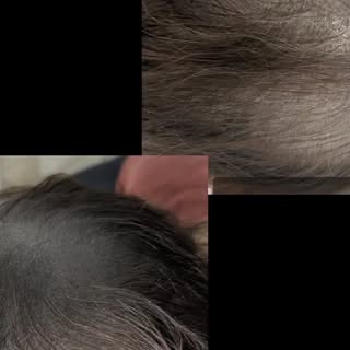 Cette cliente est venue me voir pour rattraper une tricopigmentation effet densité, réalisée chez un