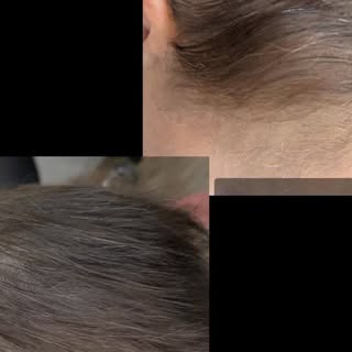 Rattrapage d'une tricopigmentation effet densité ⚡⚡

#tricopigmentation #pertedecheveux #pertedechev