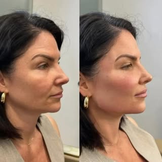 Turn back the clock with a customized non surgical Full Face Rejuvenation with SurgMed Health✨#surgm