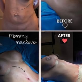 Mommy Makeover with SurgMed Health ✨
Your body, your confidence, your transformation. 💕
📩 DM us fo