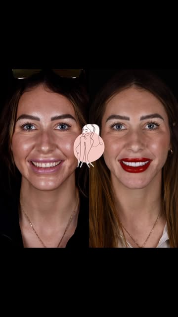 ✨ Feel the confidence with your new smile!
Transform your smile with Surgmed Health 🦷✨

#NewSmile #