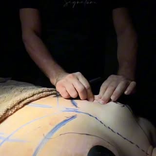 📍Dans ce cas, la patiente présentait une poitrine très tombante, avec une perte de fermeté importan