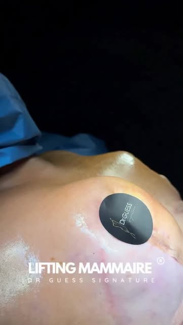 📍Dans ce cas, la patiente présentait une poitrine très tombante, avec une perte de fermeté importan