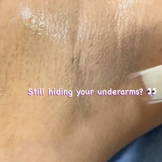 Still hiding your underarms ? 👀

Underarm pigmentation is more common than you think—and in many ca