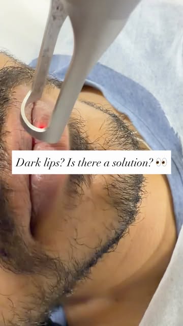 Dark lips? Is there a solution? 👀

Yes — lip pigmentation can be treated. ✨
With the right evaluati