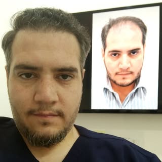 قبل و بعد 👴👨 #زراعة_شعر #زراعة_شعر_في_الرياض #زراعة_اللحية #زراعة_لحية #زراعة_حواجب #زراعة_الحواجب