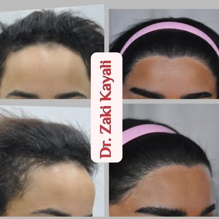 زراعة شعر للمنابت و الحواجب تمت على مرحلتين
حيث كانت أول جلسة بطريقة الشريحة و الثانية بالاقتطاف للت