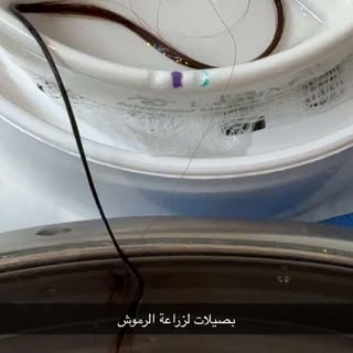 زراعة الرموش بعد عملية سابقة لتوسيع العين
