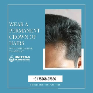 With FUE technique, which targets the perfect result, your new hair follicles are planted in the dir