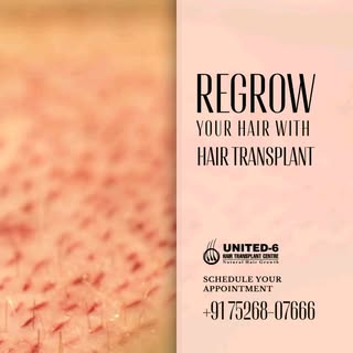 ❖ Minimal recovery time
❖ Suitable for both men and women
Website: https://united6hairtransplant.com