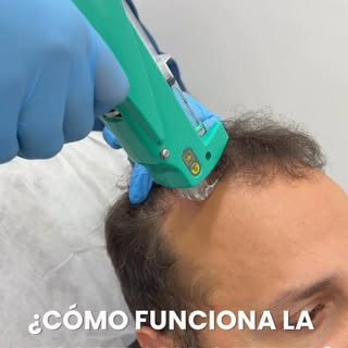 ¿Cómo funciona la mesoterapia capilar?

La mesoterapia capilar es un tratamiento mínamente invasivo 