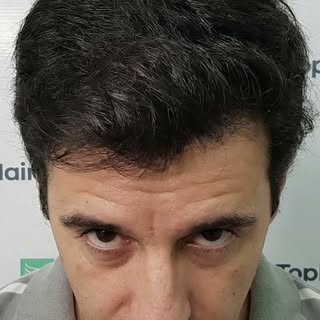 Pensar en un implante capilar ahora es más fácil. Financiación con BBVA hasta en 36 cuotas a tasa 0%