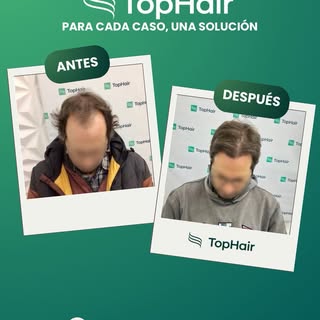 La diferencia entre un implante capilar y un resultado verdaderamente natural está en los detalles.
