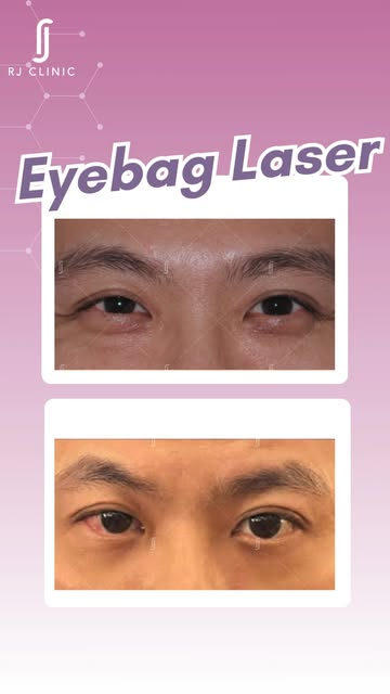 Before vs after with RJ Acculift Eyebag Laser, no cuts, just a fine laser fibre melting excess fat a