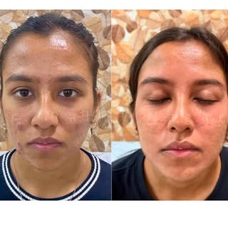 ✨ Acne is the most common skin problem for which patients seek medical consultation from dermatologi