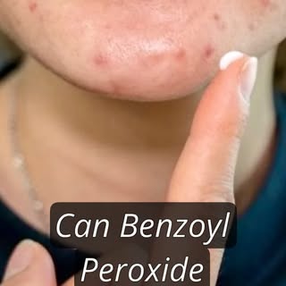 😡 INSANE FEAR-MONGERING ! 

🧪 Benzoyl Peroxide (BPO) is a SAFE and EFFECTIVE anti acne medication 