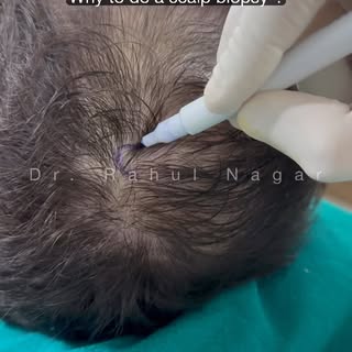 🎯 SCALP BIOPSY 

👉🏻 Most of the hair disorders are caused by problems in the hair roots. Hair roo
