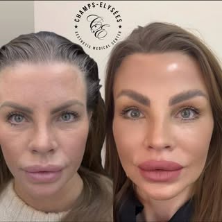 Day 7 Post Gliding Brow Lift, Real Results ✨

Camilla shares her experience just 7 days after her Gl