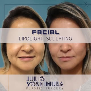 🇺🇸A new approach to facial lipoesculture, focused on strategic reduction of fat areas and reuse of