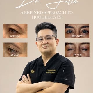 A refined approach to hooded eyes.

In this video, Dr. Julio outlines the key principles behind succ