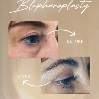 The difference is in what you don’t see. 😉

Expert blepharoplasty means invisible scars, balanced r