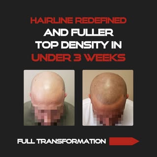 From an advanced receded hairline to a natural, fuller-looking front - this transformation shows jus