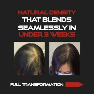 She came to us feeling self-conscious about how much scalp was showing through her parting.

With su