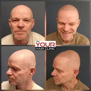 From no hair, to the look of a full head of shaved hair! We're very happy to put a smile back on his