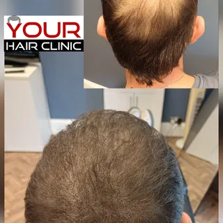 Here's a progress picture of scalp micro-pigmentation making a massive difference to a thinning crow
