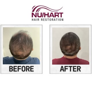 Sharing my patient’s 6-month treatment progress! 💪
Not all patients are ready for a transplant righ