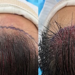 The beauty of preview long hair FUE technique ✨
You get an immediate glimpse of how your results wil