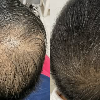 Every hair loss has its story.

With proper assessment, patience, and the right treatment plan, prog