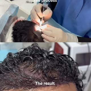 No shave. No obvious signs. No need to put life on hold.

With Long Hair FUE, hair transplantation c