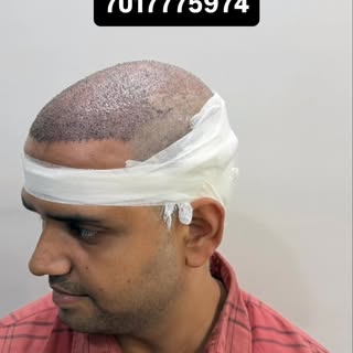 🔥 “Hair Transplant के तुरंत बाद बाल ऐसे दिखते हैं! 😱”

“आज हमारे पेशेंट का Hair Transplant success