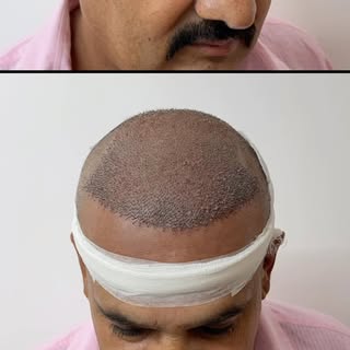 🚨 45 Years Young & Ready for a Fresh New Look! 💇‍♂️

आज हमारे 45 वर्षीय क्लाइंट का Hair Transplant