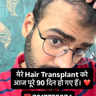 90 DAYS COMPLETE! 🔥 | MY HAIR TRANSPLANT JOURNEY

90 दिन पहले शुरू हुई थी मेरी Hair Transplant Jour