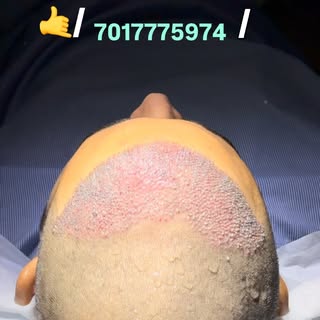 🇮🇳#hair #fue #hairtransformation #turkey #hairstyles 

Hair Transplant Result, Hair Transplant Ind