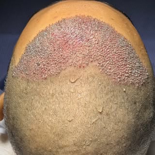 Hair Transplant तो बहुत लोग कराते हैं… लेकिन असली फर्क पता चलता है Transplant के बाद की Service से!”