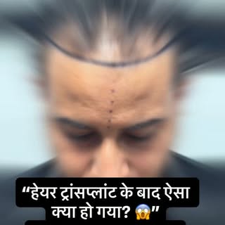 👉 “ये थी शुरुआत… Hairline काफी पीछे जा चुकी थी!
🔥 BEFORE ➜ HAIR TRANSPLANT ➜ TRANSFORMATION 🔥

कभ