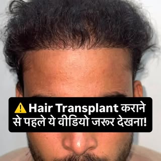 ⚠️ Hair Transplant कराने से पहले ये वीडियो जरूर देखना!

क्योंकि बाल लगाना आसान है…
लेकिन Natural Hai