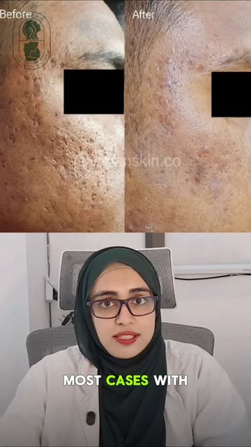 Acne may heal, but the scars it leaves behind can stay longer than expected. 🧴✨

The good news? Acn