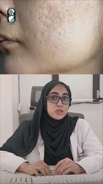 Ice pick scars can be stubborn—but the right treatment can help improve their appearance. 

TCA CROS