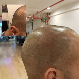 Alopecia no more! #scalpmicrousa #scalpmicro #smp