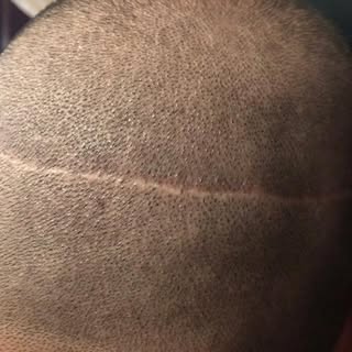 Scar Camouflage Session 😎
.
.
.
.
.
.
.
.
.
.

Before & After! #scalpmicropigmentation #scarcoverup