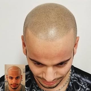 From bald to buzz cut! 😁