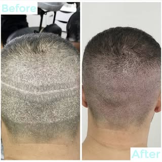 FUE and FUT scars concealed! 🤙

#scalpmicropigmentation #scarcoverup #camouflage